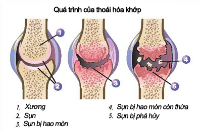 Ăn gì để phòng chữa thoái hóa khớp? 