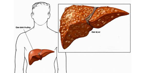 rượu gây xơ gan